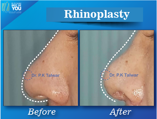 rhinoplasty surgery result